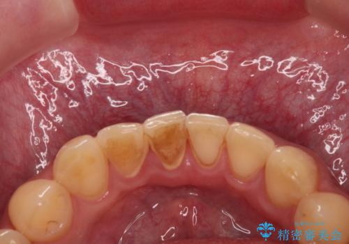 歯の着色を除去し、きれいな歯に!の治療前