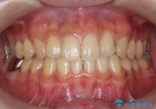 歯の着色を除去し、きれいな歯に!