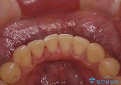 歯の着色を除去し、きれいな歯に!の治療後