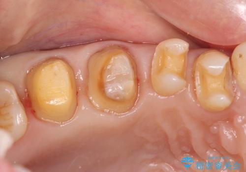 銀歯を白くしたい セラミックによる審美歯科治療の治療中