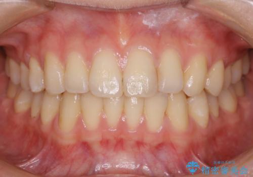 【非抜歯】部分矯正で自信の持てる歯並びへの治療後