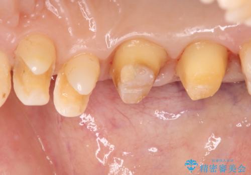 銀歯を白くしたい セラミックによる審美歯科治療の治療中