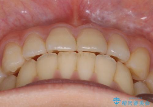 【非抜歯】部分矯正で自信の持てる歯並びへの治療後