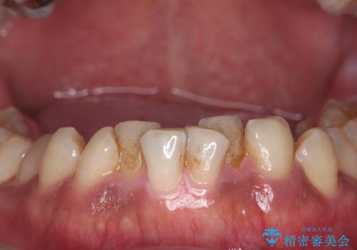 コーヒー、タバコなどで着色した歯をPMTCで、きれいに!!の治療前