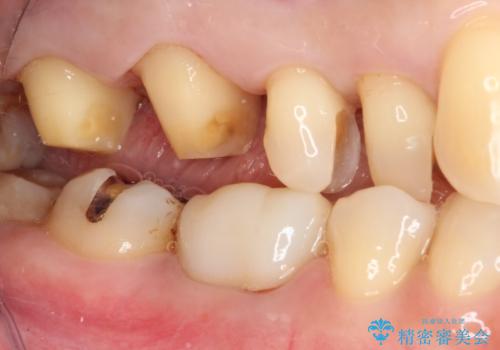 銀歯を白くしたい セラミックによる審美歯科治療の治療中