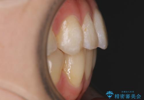 【非抜歯】部分矯正で自信の持てる歯並びへの治療後