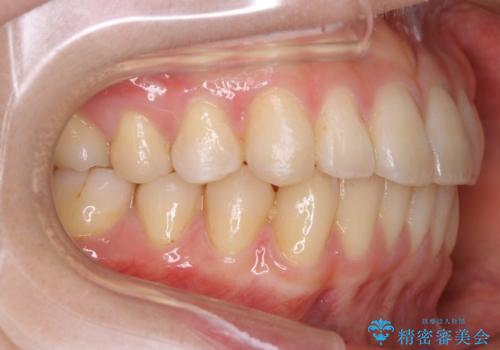 【非抜歯】部分矯正で自信の持てる歯並びへの治療後
