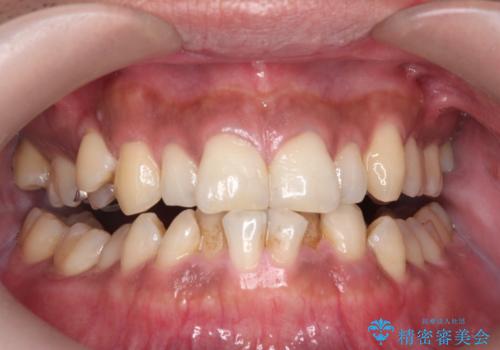 コーヒー、タバコなどで着色した歯をPMTCで、きれいに!!の治療前