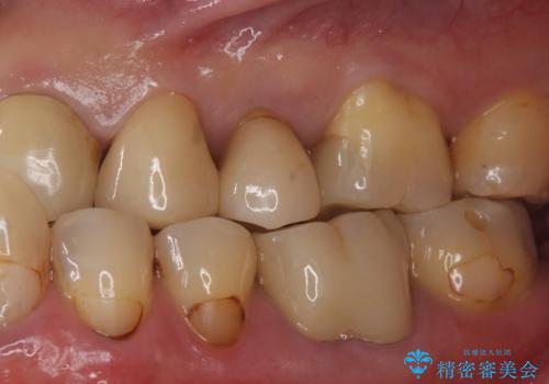 銀の詰め物をやりかえたいの治療後
