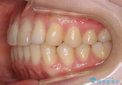 【非抜歯】部分矯正で自信の持てる歯並びへの治療後