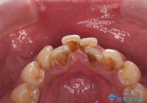 コーヒー、タバコなどで着色した歯をPMTCで、きれいに!!の治療前