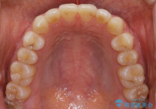 【非抜歯】部分矯正で自信の持てる歯並びへの治療後