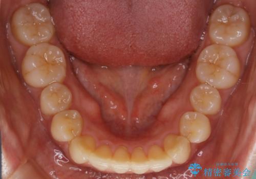 【非抜歯】部分矯正で自信の持てる歯並びへの治療後