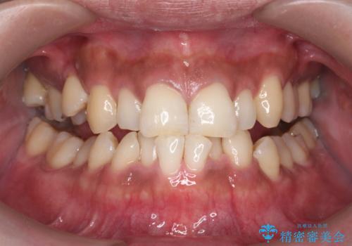 コーヒー、タバコなどで着色した歯をPMTCで、きれいに!!の症例 治療後