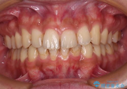 前歯のデコボコをスッキリ改善 インビザライン矯正の治療中