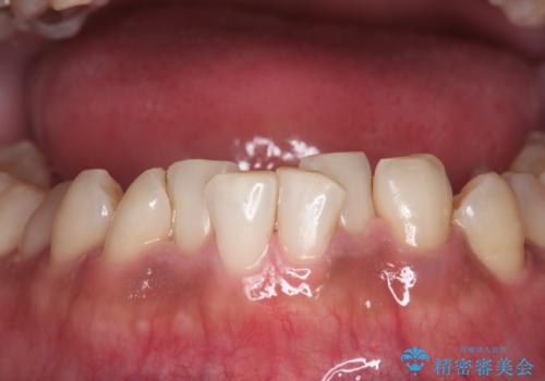 コーヒー、タバコなどで着色した歯をPMTCで、きれいに!!の治療後