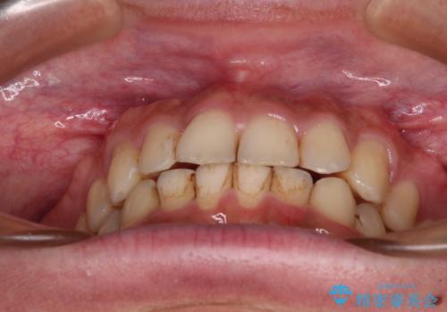 前歯のデコボコをスッキリ改善 インビザライン矯正の治療中