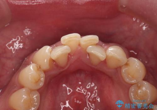 コーヒー、タバコなどで着色した歯をPMTCで、きれいに!!の治療後