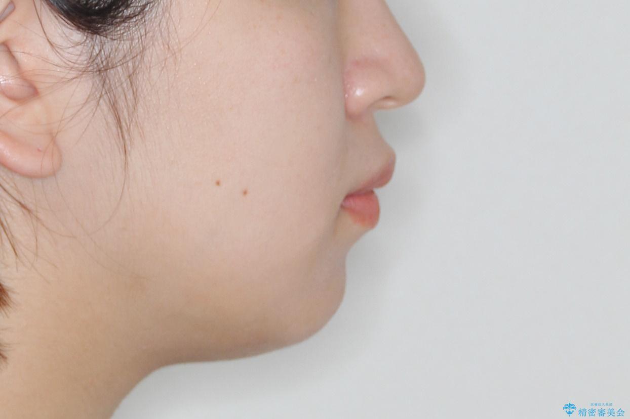 ワイヤーによる抜歯矯正でガタガタの改善の治療前(顔貌)