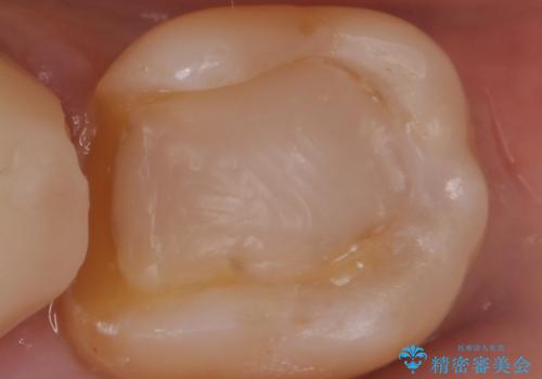 銀を白くしたいの治療中