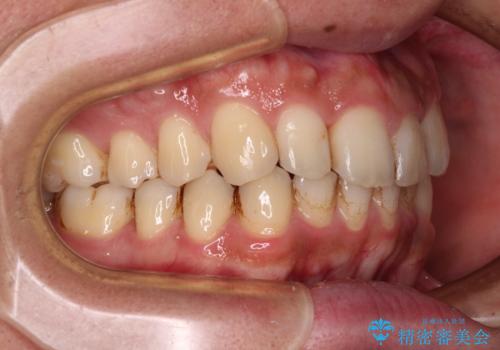 前歯のデコボコをスッキリ改善　インビザライン矯正の治療中