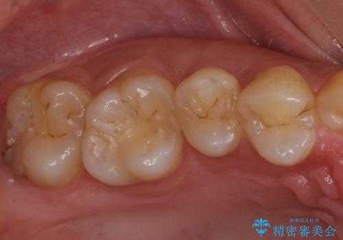 セラミック治療の治療前