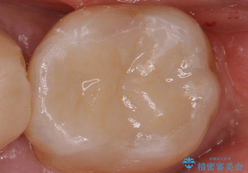 銀を白くしたいの症例 治療後