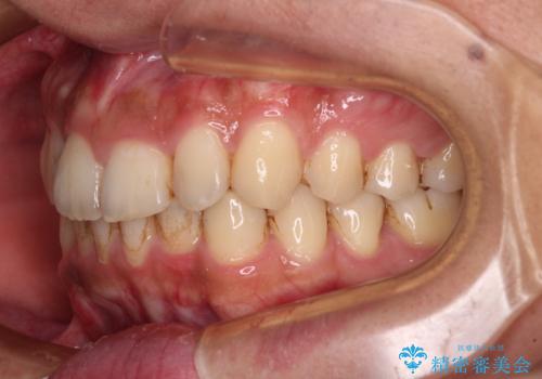 前歯のデコボコをスッキリ改善 インビザライン矯正の治療中