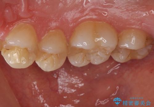 セラミック治療の治療前