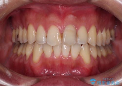 ワイヤー装置をインビザラインへ 装置変更での矯正治療の治療後