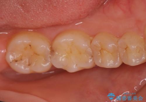 矯正終了後、詰め物を綺麗にしたい。セラミック治療の症例 治療前