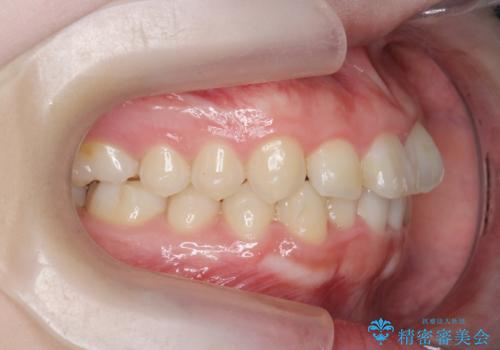 前歯の見た目を改善したいの治療中