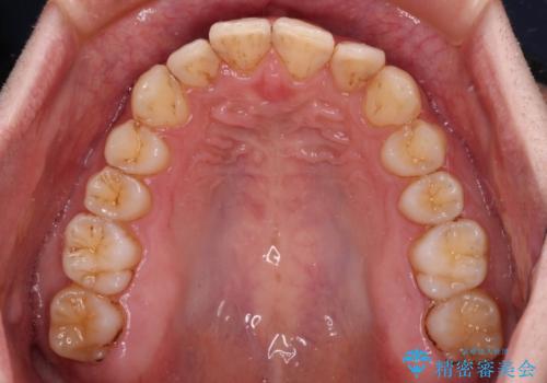 前歯のデコボコをスッキリ改善 インビザライン矯正の治療中