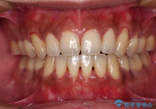 隙間が空いて突出した前歯を治したい　ワイヤー装置による抜歯矯正