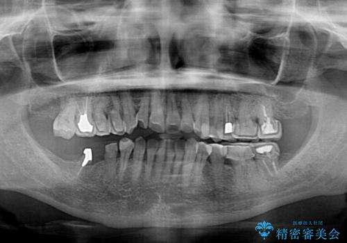 治療後に歯茎から出血 インプラントとオールセラミッククラウンの補綴治療の治療前