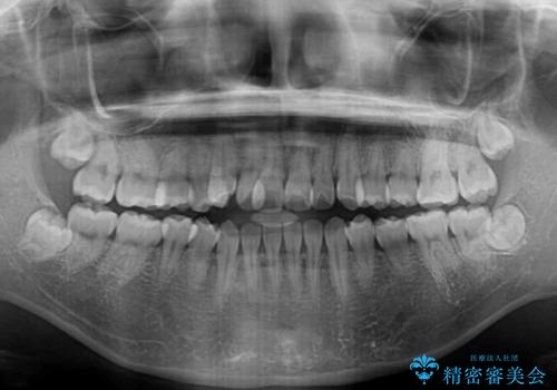 急速拡大装置　狭い上顎骨を拡大してワイヤー装置で短期間治療の治療前