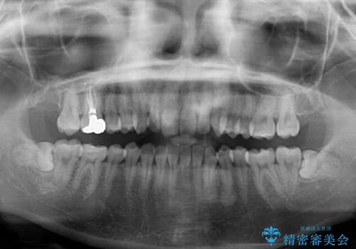 転勤予定がある インビザラインによる矯正治療の治療前