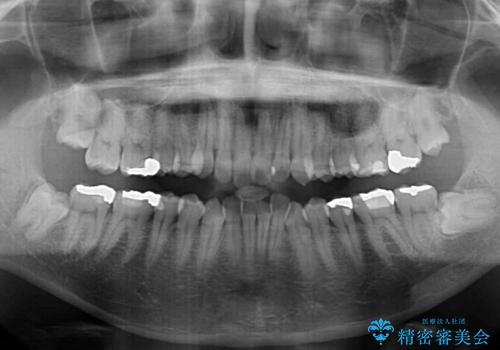 ワイヤー装置をインビザラインへ 装置変更での矯正治療の治療前