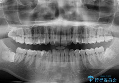 前歯のデコボコをスッキリ改善 インビザライン矯正の治療前