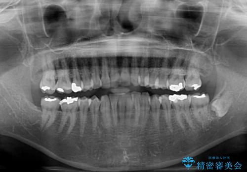 インビザラインでのんびりと矯正治療 の治療前