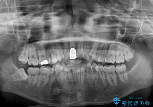 八重歯とクロスバイト 目立たないワイヤー装置での抜歯矯正の治療前