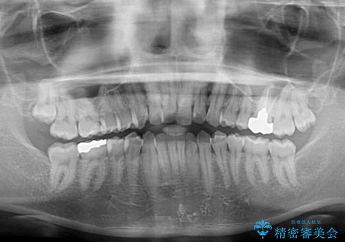 前歯のデコボコを治したい ワイヤー装置でお手軽に矯正治療の治療前
