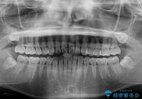 すきっ歯とオープンバイト インビザライン・ライトで改善の治療前
