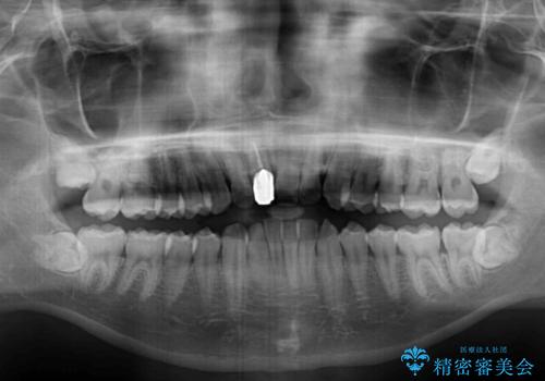 前歯のデコボコを治したい インビザライン矯正治療の治療前