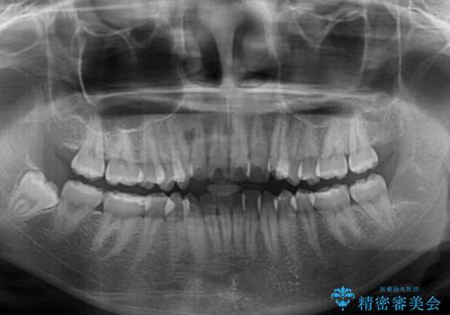 【モニター】八重歯と前歯のクロスバイト ワイヤーを併用しインビザラインで矯正治療の治療前