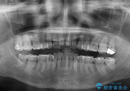 矯正治療の後戻り インビザライン・ライトでの再矯正の治療前