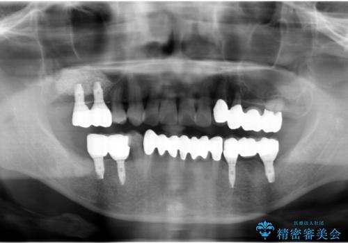 インプラント治療を併用した全顎歯周病治療の治療後