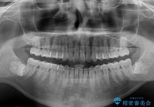 前歯のデコボコをスッキリ改善 インビザライン矯正の治療後
