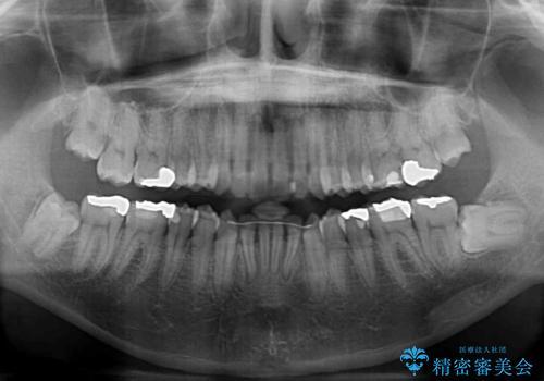 ワイヤー装置をインビザラインへ 装置変更での矯正治療の治療後