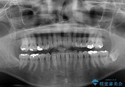 インビザラインでのんびりと矯正治療 の治療後